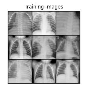 chest-x-ray-pneumonia-dataset-images