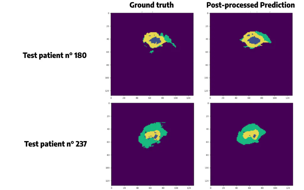 Post-processed predicted segmentation vs ground truth segmentation for the BraTS2020 dataset