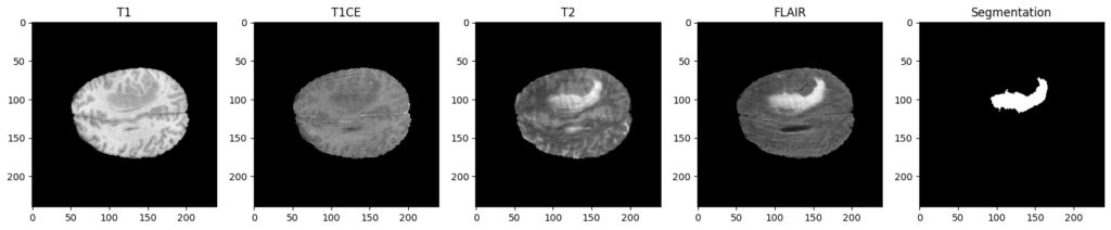 Display of 4 MRI images from the BraTS2020 dataset, and a tumor segmentation