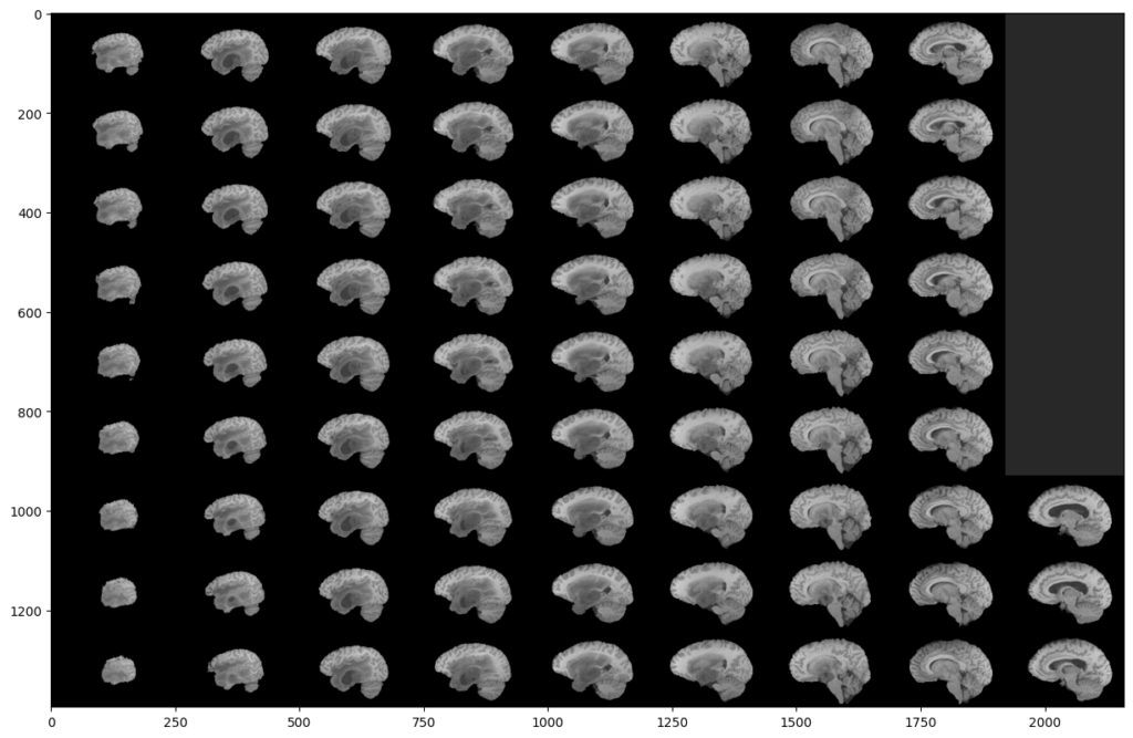 some slices of a BraTS2020 MRI modality