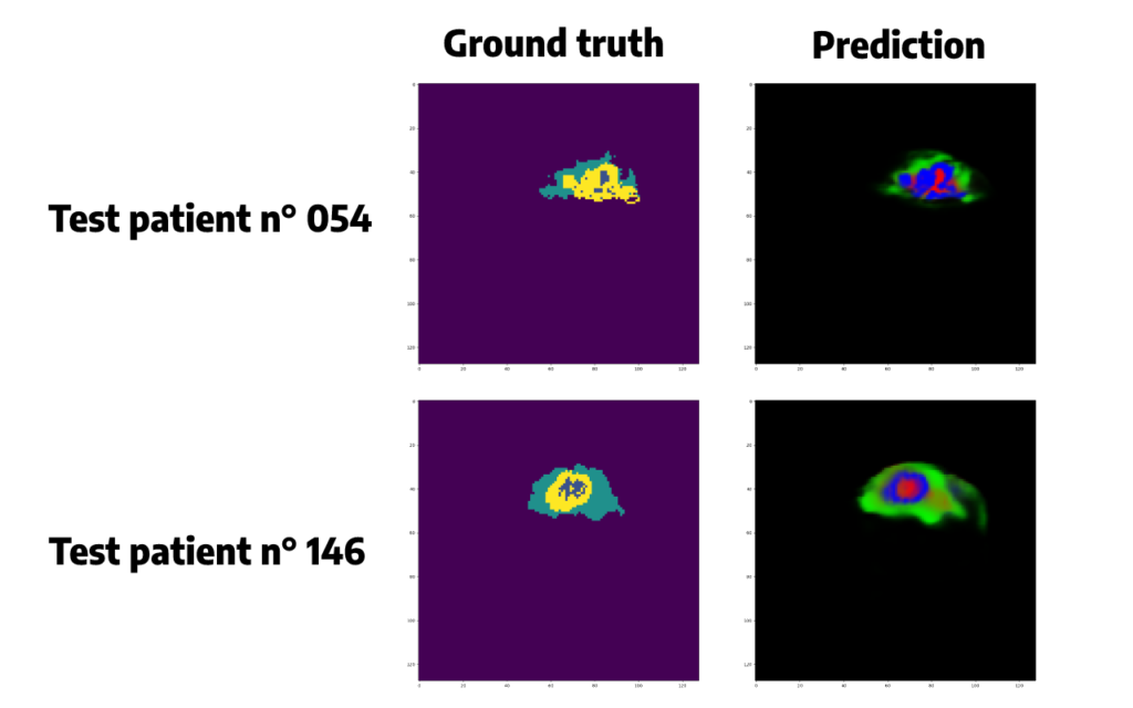 Predicted segmentation vs ground truth segmentation for the BraTS2020 dataset